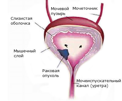 Злокачественная опухоль мочевого пузыря